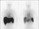 AA Amyloidosis Treatment