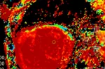 cardiac-amyloidosis-misfolding.jpg